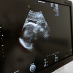 Ultraschall Bauchuntersuchung Schwangerschaft